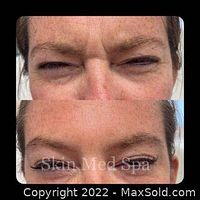 Before and after eye area showing reduced fine lines