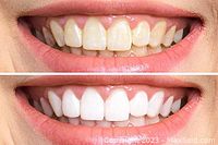 Before and after use photo showing effectiveness of the teeth whitening kit in brightening teeth.