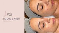 Before and after facial treatment results using JetPeel by TavTech
