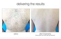 Before-and-after back hair removal results, six treatments